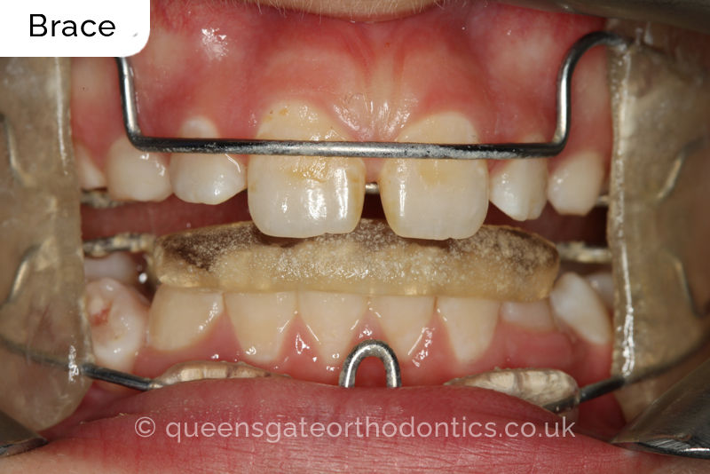 Large overjet due to short lower jaw, causing lower lip trapping and proclination of the upper incisors