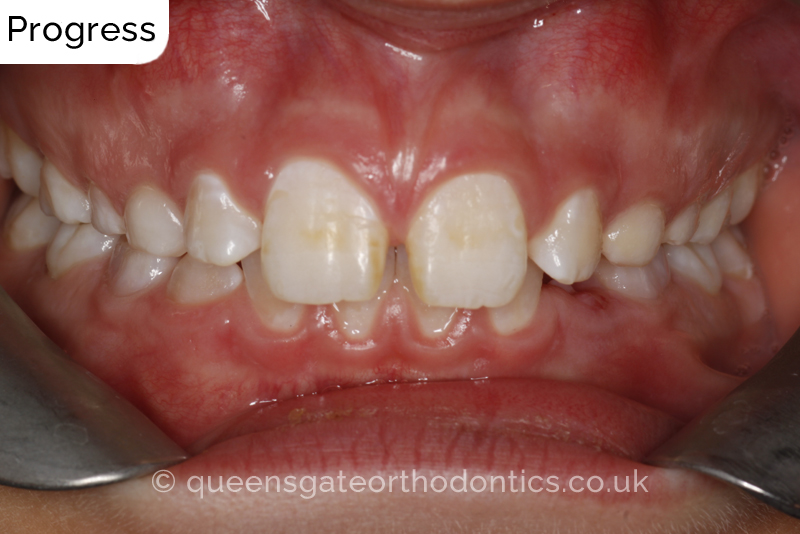 Large overjet due to short lower jaw, causing lower lip trapping and proclination of the upper incisors