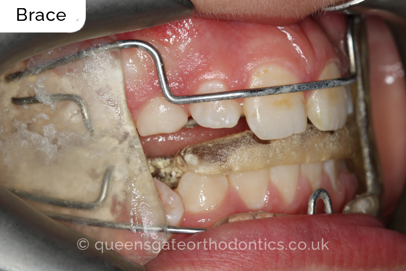 Large overjet due to short lower jaw, causing lower lip trapping and proclination of the upper incisors