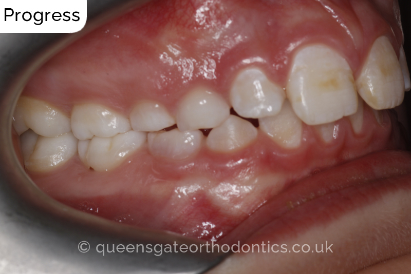 Large overjet due to short lower jaw, causing lower lip trapping and proclination of the upper incisors