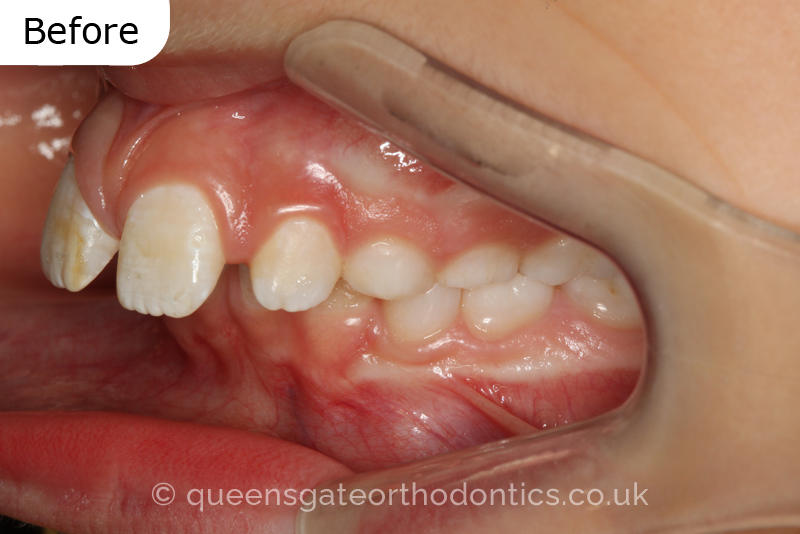 Large overjet due to short lower jaw, causing lower lip trapping and proclination of the upper incisors