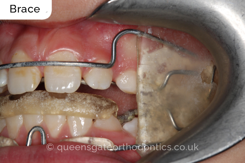 Large overjet due to short lower jaw, causing lower lip trapping and proclination of the upper incisors