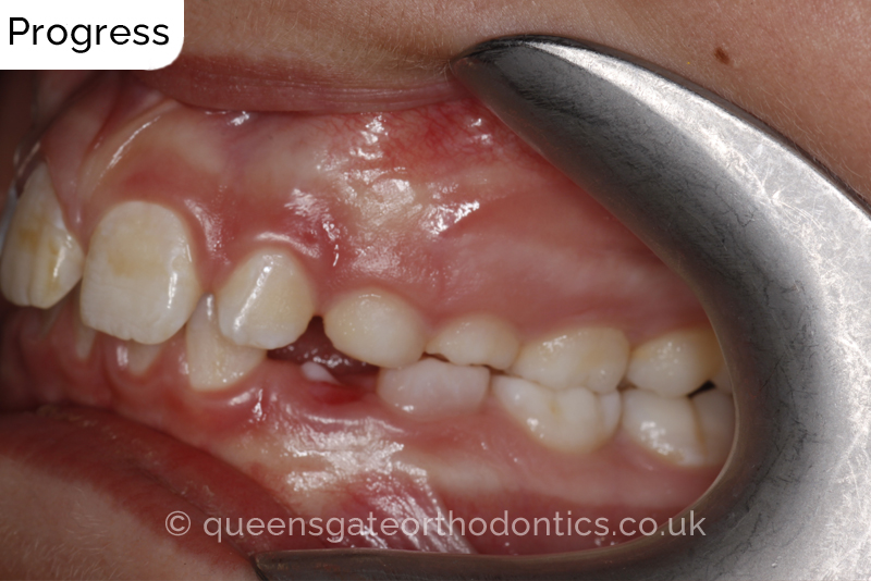 Large overjet due to short lower jaw, causing lower lip trapping and proclination of the upper incisors