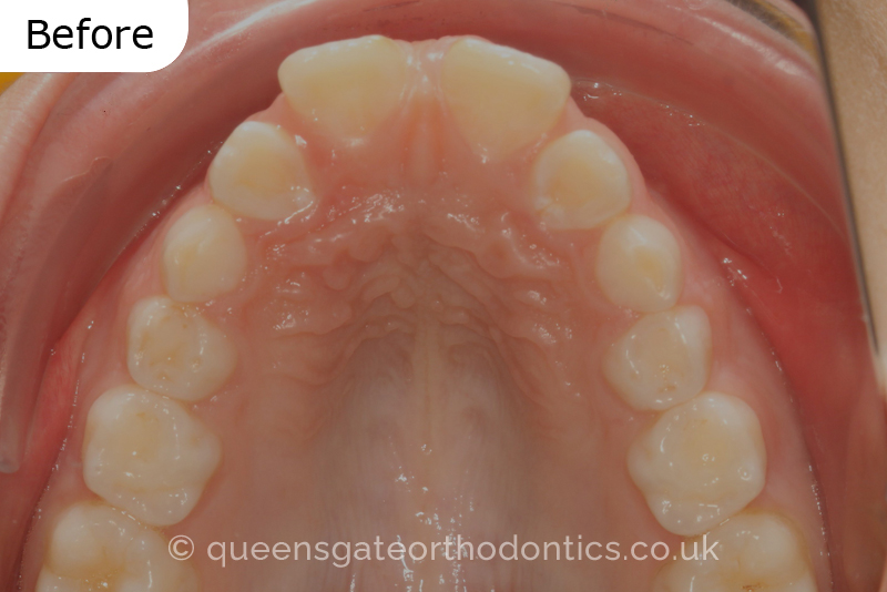 Large overjet due to short lower jaw, causing lower lip trapping and proclination of the upper incisors