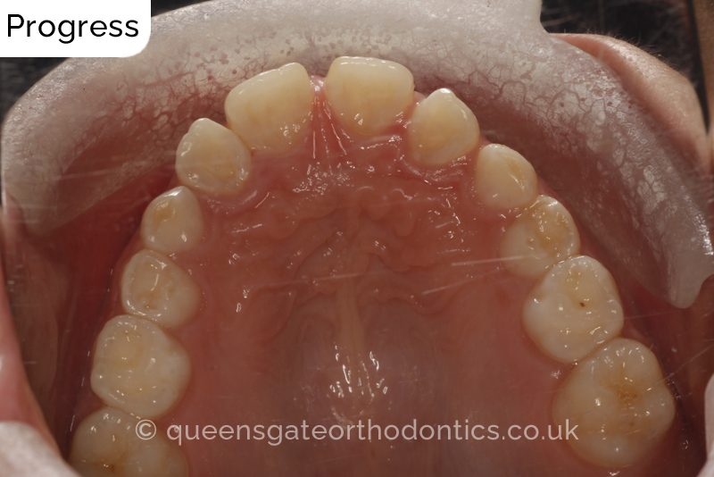 Large overjet due to short lower jaw, causing lower lip trapping and proclination of the upper incisors