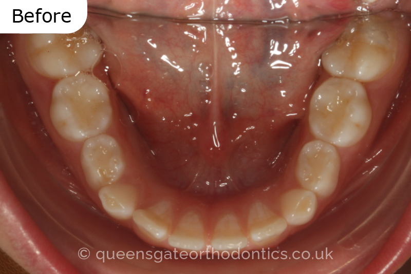 Large overjet due to short lower jaw, causing lower lip trapping and proclination of the upper incisors