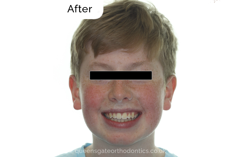 Impacted upper left central incisor and crossbite onright side