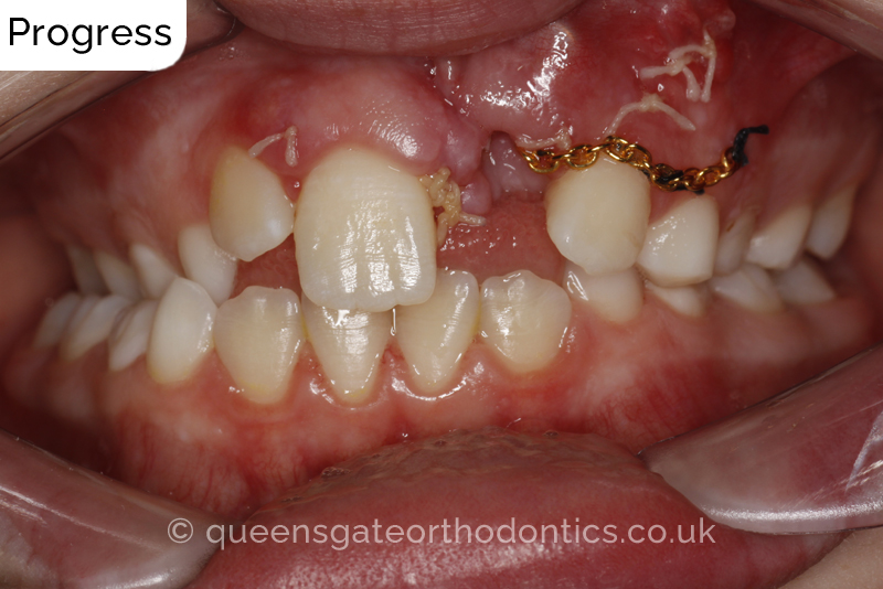 Impacted upper left central incisor and crossbite onright side