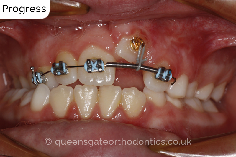 Impacted upper left central incisor and crossbite onright side