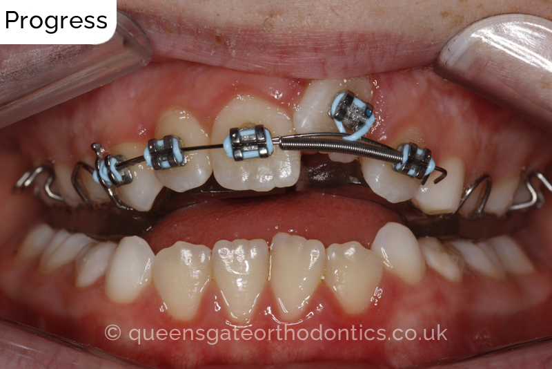 Impacted upper left central incisor and crossbite onright side