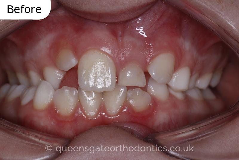 Impacted upper left central incisor and crossbite onright side