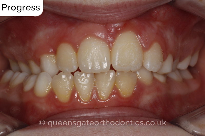 Impacted upper left central incisor and crossbite onright side