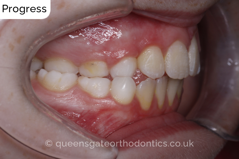 Impacted upper left central incisor and crossbite onright side