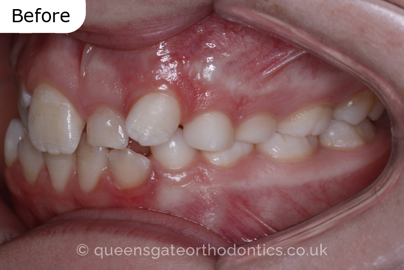 Impacted upper left central incisor and crossbite onright side