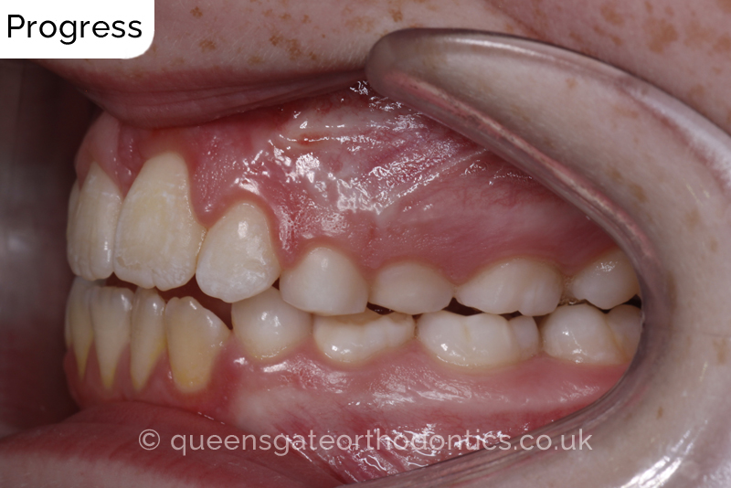 Impacted upper left central incisor and crossbite onright side