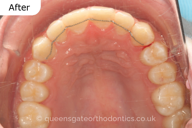 Impacted upper left central incisor and crossbite onright side