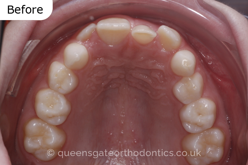 Impacted upper left central incisor and crossbite onright side