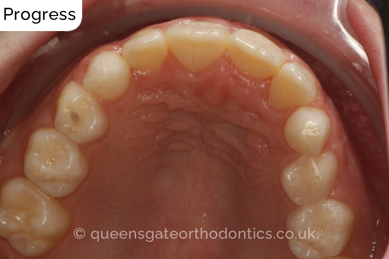 Impacted upper left central incisor and crossbite onright side