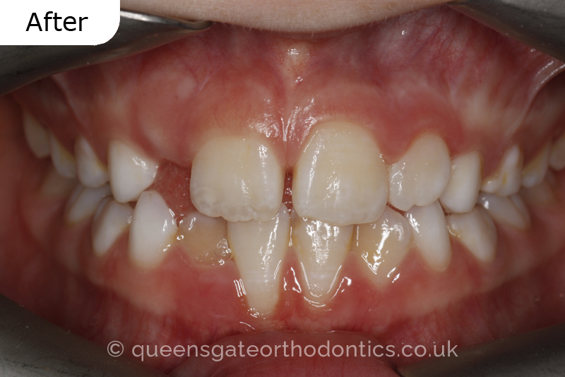 Anterior crossbite