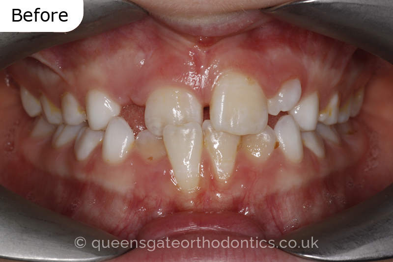 Anterior crossbite