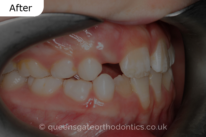 Anterior crossbite