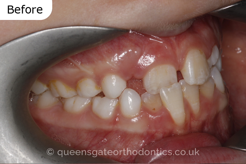 Anterior crossbite