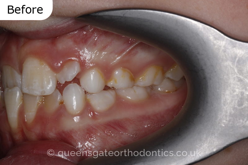 Anterior crossbite