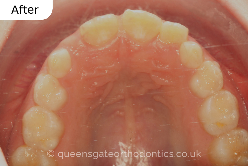 Anterior crossbite