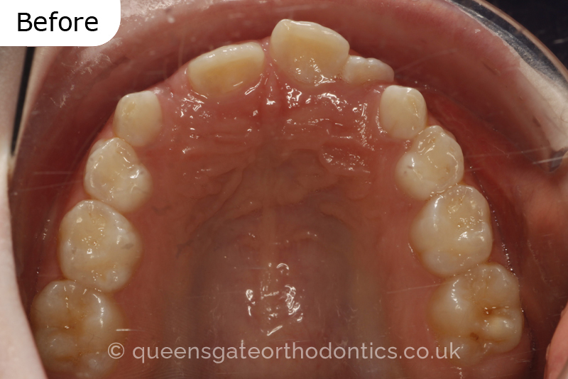 Anterior crossbite