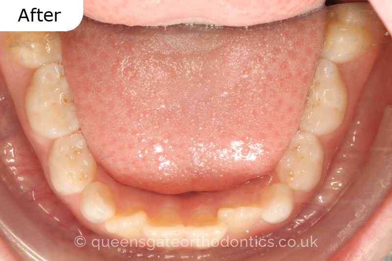 Anterior crossbite