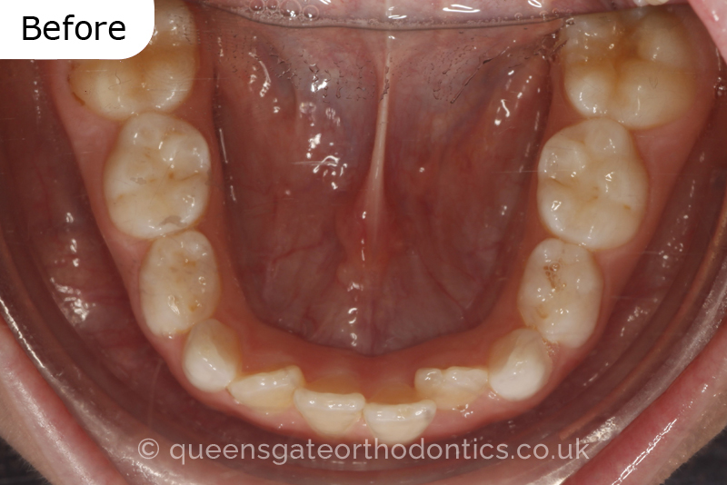 Anterior crossbite