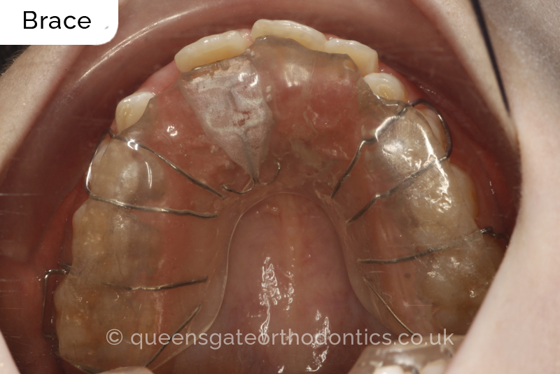 Anterior crossbite