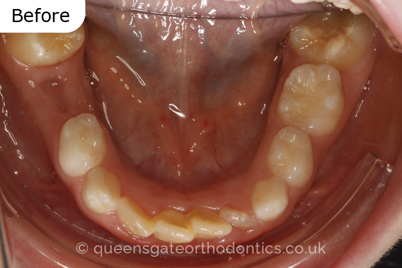 Anterior crossbite