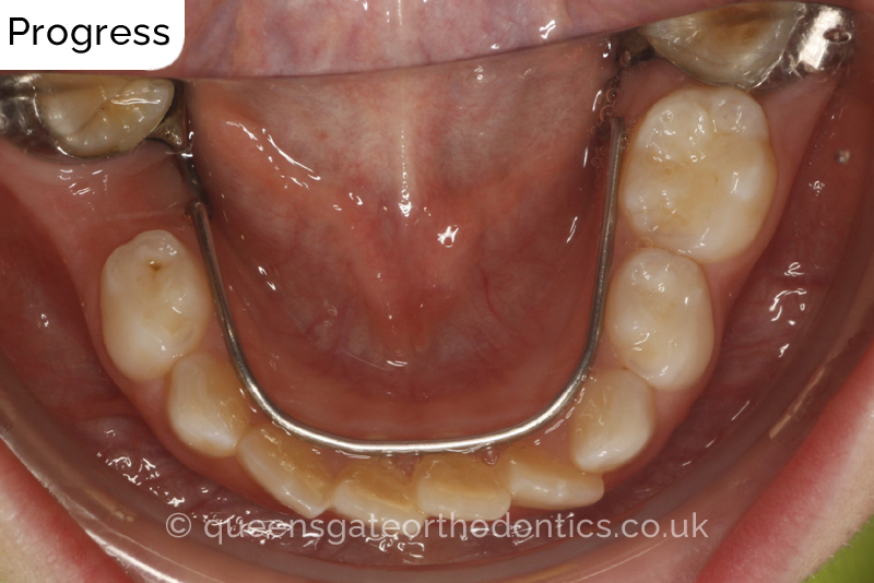 Anterior crossbite