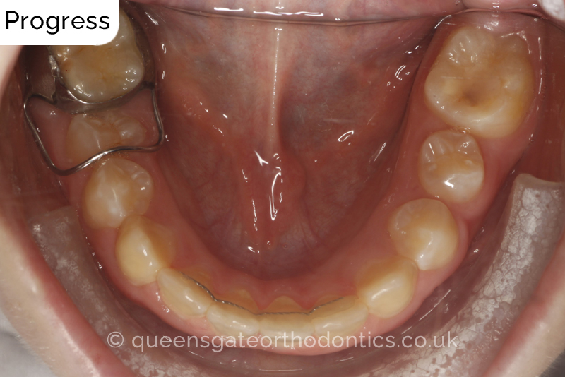 Anterior crossbite