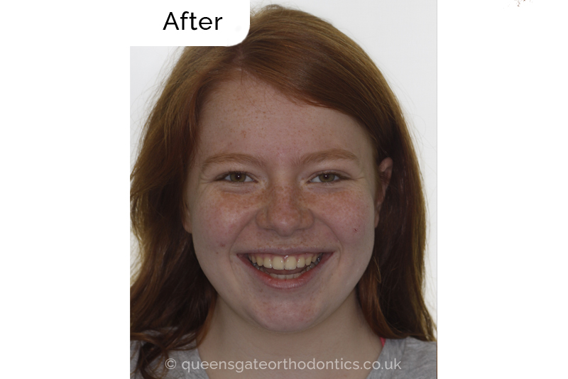 Anterior crossbite and crowded teeth corrected with aremovable expander brace and fixed braces