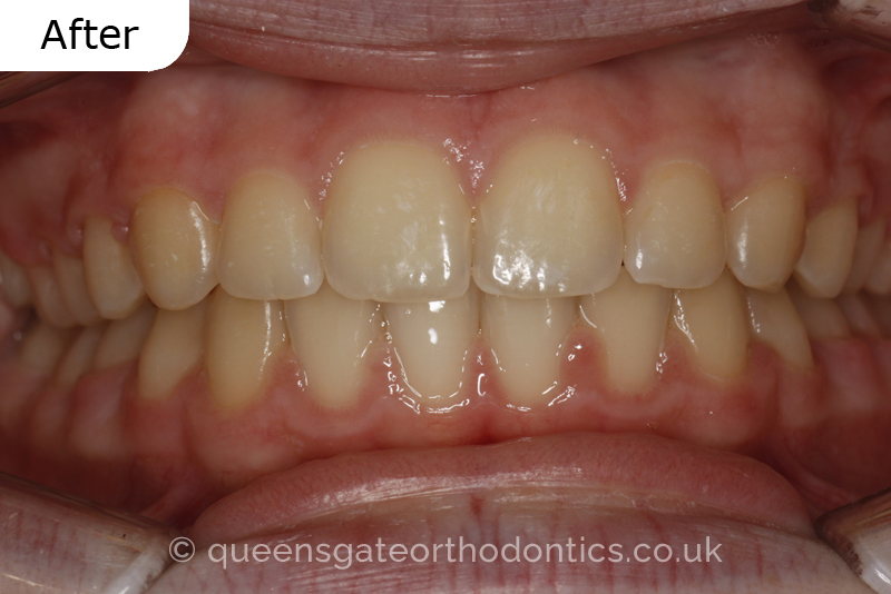 Anterior crossbite and crowded teeth corrected with aremovable expander brace and fixed braces