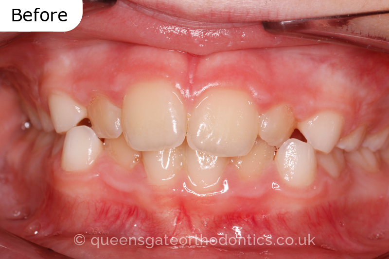 Anterior crossbite and crowded teeth corrected with aremovable expander brace and fixed braces