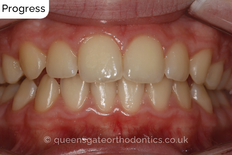 Anterior crossbite and crowded teeth corrected with aremovable expander brace and fixed braces