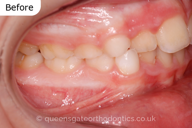 Anterior crossbite and crowded teeth corrected with aremovable expander brace and fixed braces