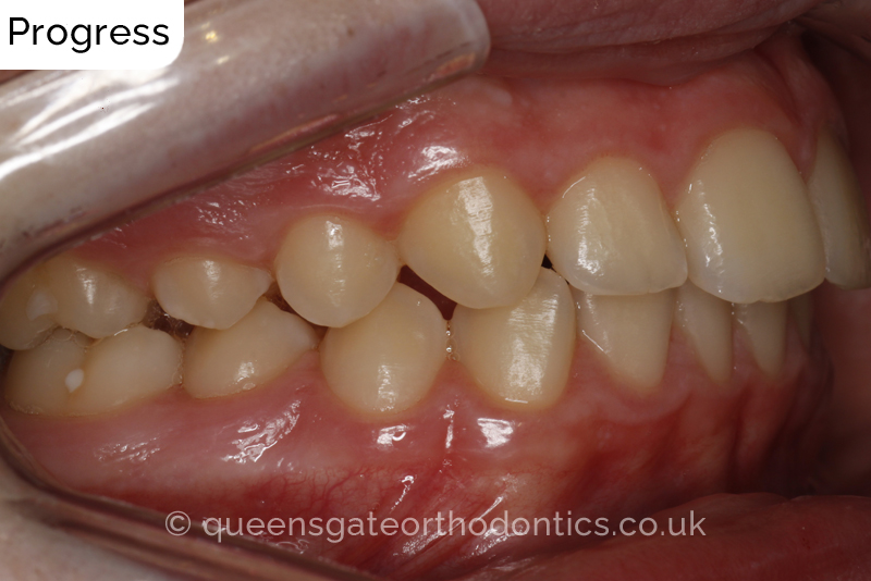 Anterior crossbite and crowded teeth corrected with aremovable expander brace and fixed braces