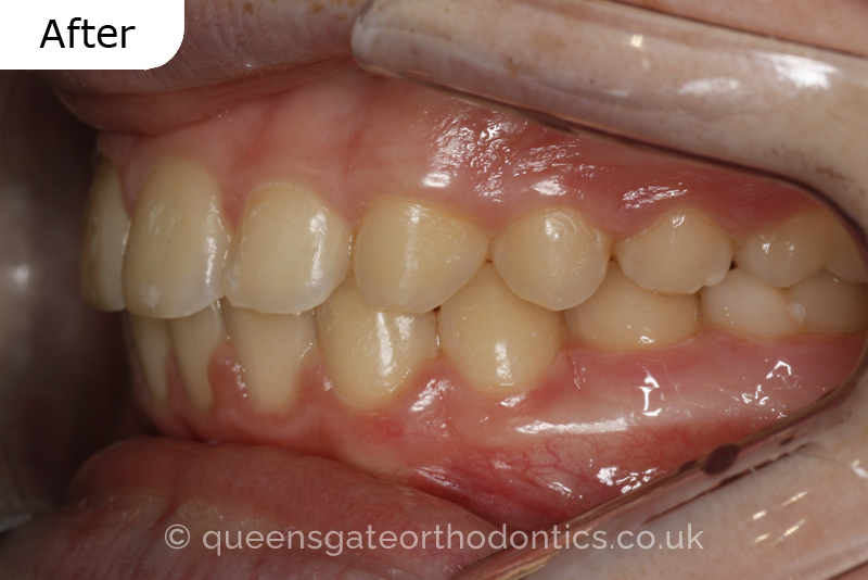 Anterior crossbite and crowded teeth corrected with aremovable expander brace and fixed braces