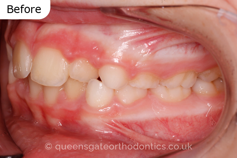 Anterior crossbite and crowded teeth corrected with aremovable expander brace and fixed braces