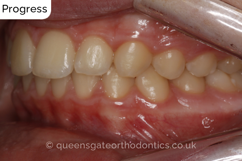 Anterior crossbite and crowded teeth corrected with aremovable expander brace and fixed braces