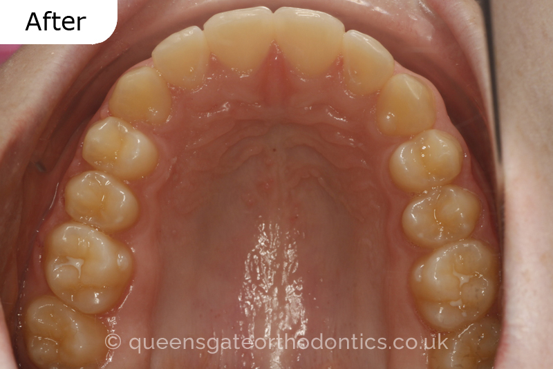 Anterior crossbite and crowded teeth corrected with aremovable expander brace and fixed braces