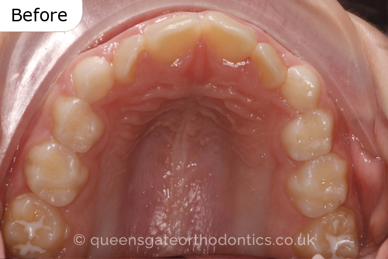 Anterior crossbite and crowded teeth corrected with aremovable expander brace and fixed braces