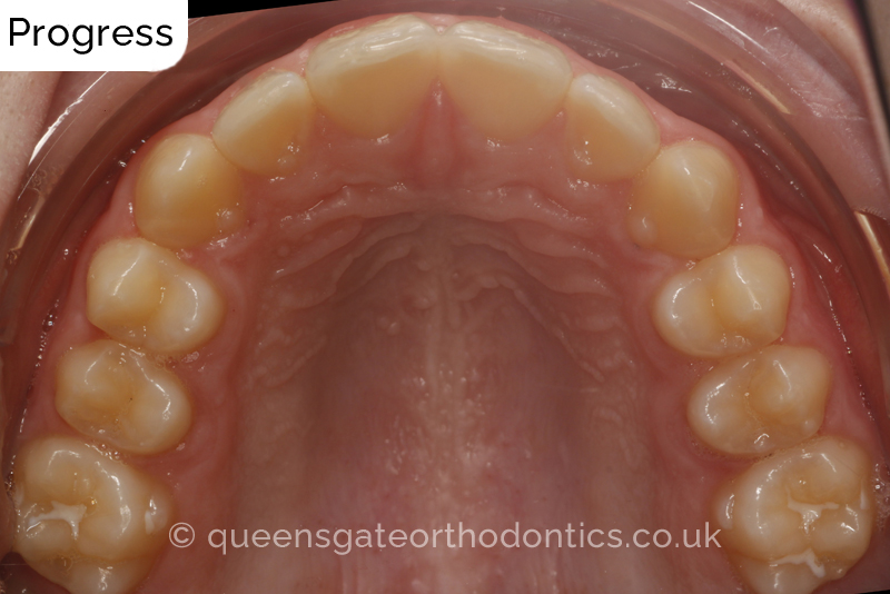 Anterior crossbite and crowded teeth corrected with aremovable expander brace and fixed braces