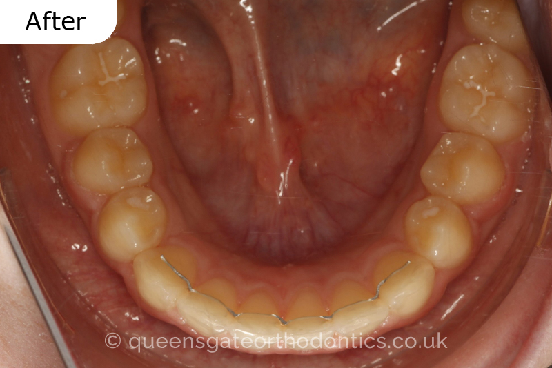 Anterior crossbite and crowded teeth corrected with aremovable expander brace and fixed braces