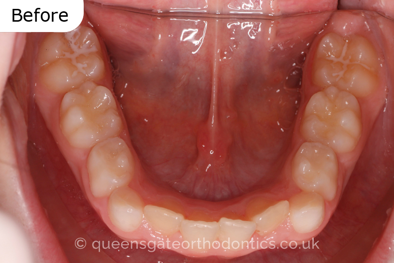 Anterior crossbite and crowded teeth corrected with aremovable expander brace and fixed braces