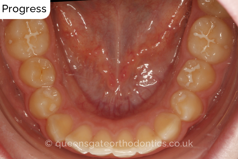 Anterior crossbite and crowded teeth corrected with aremovable expander brace and fixed braces